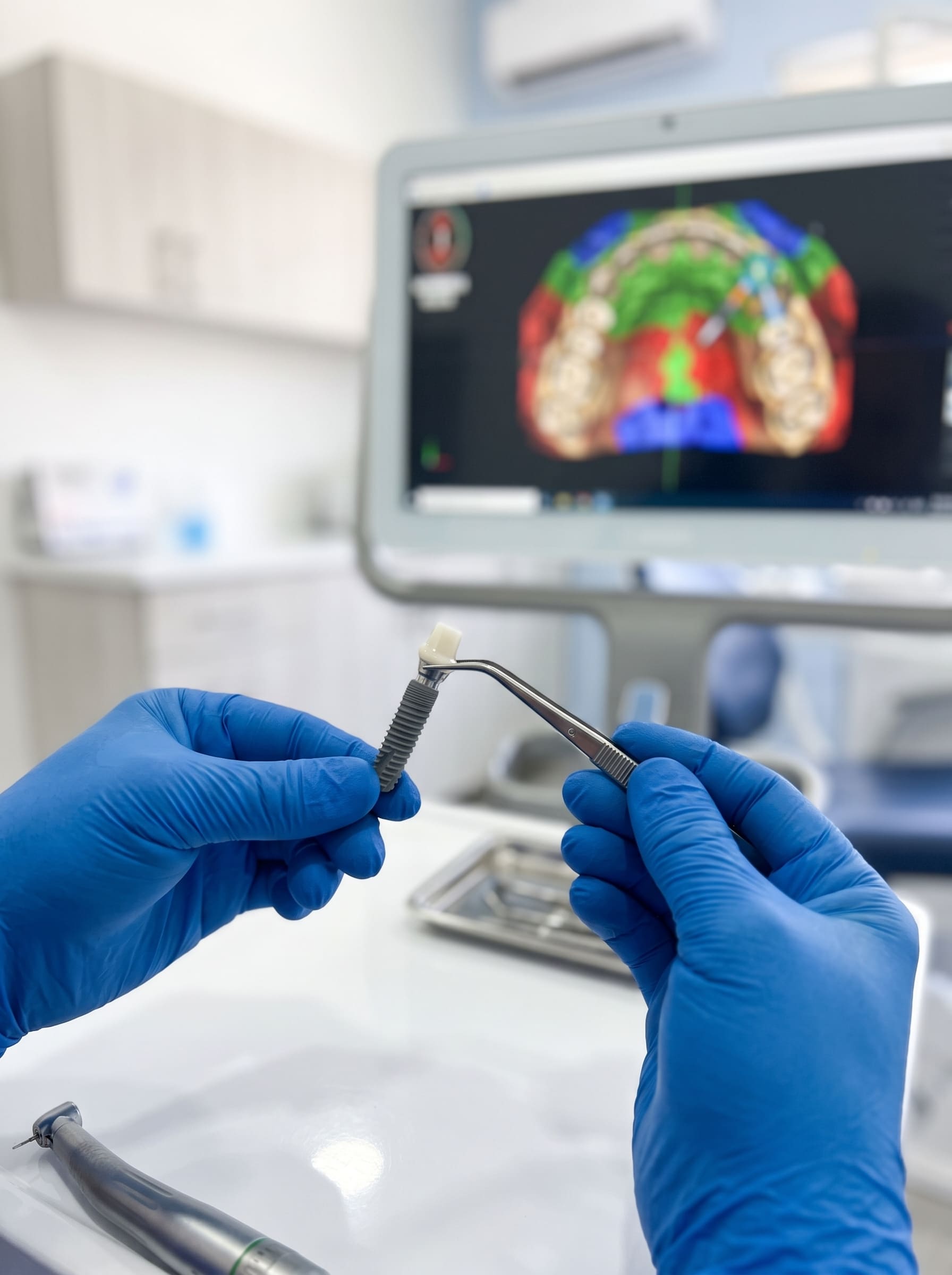 Implante dental de titanio y planeación tridimensional en Dental Correct Guadalajara.